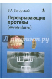 Книга Перекрывающие протезы (overdentures)